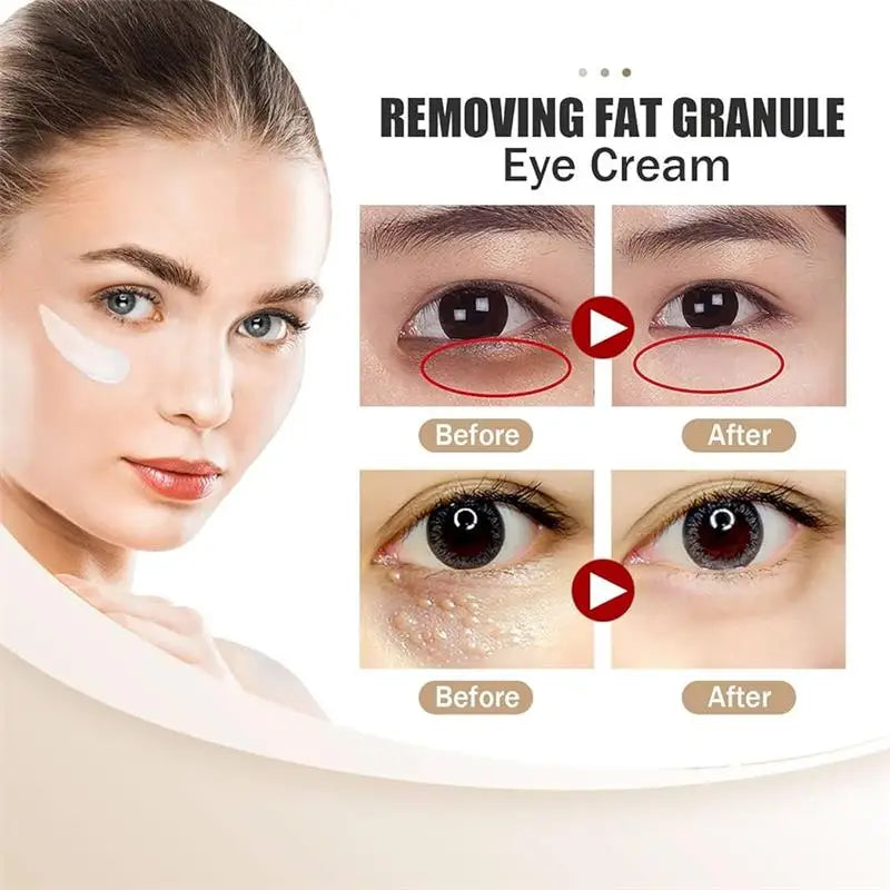 Fat Granules Remover Eye Cream Anti-Puffiness Anti Inflammatory Reduce Dark Circles Eyebags Fade Lines Moisturizing Eye Care
