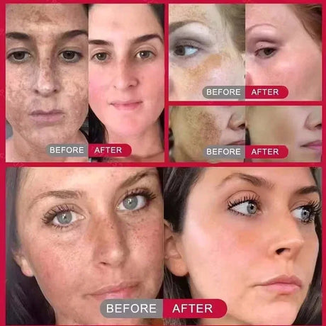 Powerful Spot-Removing Whiten Cream Brighten Skin Fast Eliminates Melanin Pigmentation Melasma Dark Spots Korean Face Skin Care