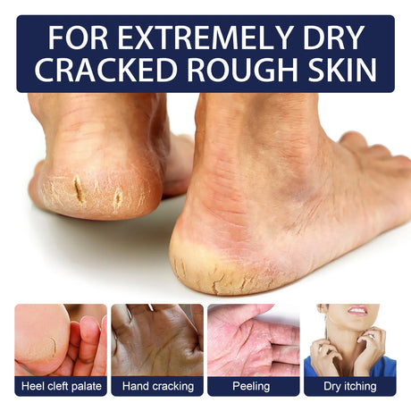 Herbal Anti Crack Foot Cream Heel Cracking Repair Products Exfoliation Dead Skin Removal Softening Moisturize Smooth Skin Care