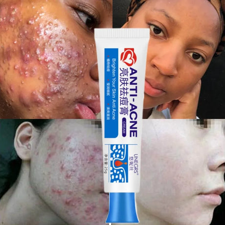 Herbal Acne Removal Face Cream Clears Pimple Scar Black Dots Gel Acne Treatment Shrink Pore Skin Whitening Lightening Ointment