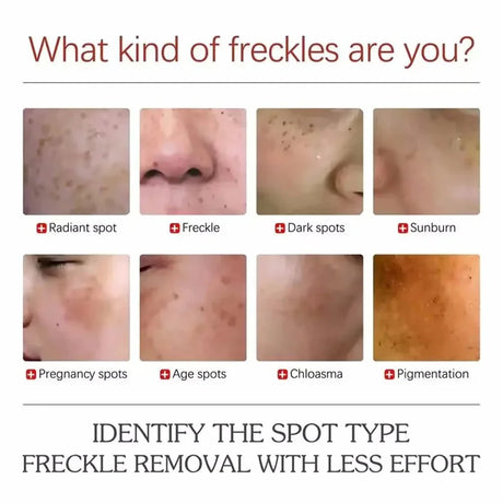 Powerful Spot-Removing Whiten Cream Brighten Skin Fast Eliminates Melanin Pigmentation Melasma Dark Spots Korean Face Skin Care
