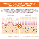 TRSTAY Stretch Mark Scar Repair Cream Enhances Skin Elasticity Moisture Collagen Improvement Safe And Effective