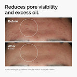 10% Niacinamide 1% Zinc Face Serum 30ml, Oil Control Pore Minimizer, Anti-Acne Dark Spot, Gentle Skin Care for All Skin Types