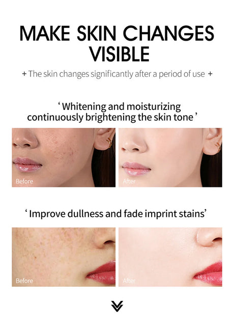 Powerful Spot-Removing Whiten Cream Brighten Skin Fast Eliminates Melanin Pigmentation Melasma Dark Spots Korean Face Skin Care