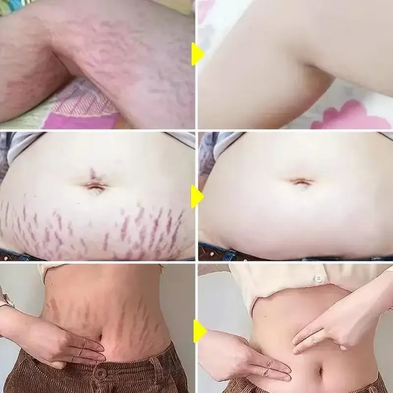 Stretch Marks Repair Cream Fade Lines Improve Duliness Tightness Long-lasting Moisturizing Smooth Enhance Elasticity Body Care