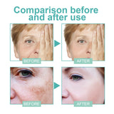 Powerful Spot-removing Whitening Freckles Cream Remove Melasma Dark Spots Fade Pigmentation Acne Moisturizing Brighten Skin Care