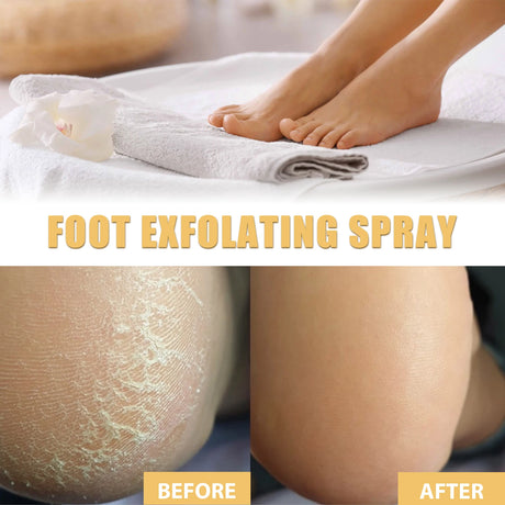 Ouhoe Foot Exfoliating Spray 72H Moisture Lock Callus Softener Anti Dry Crack Repair Odor Control Brightening Foot Care Liquid