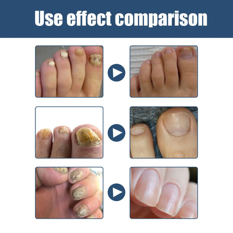 South Moon Foot Spray Anti Smell Remove Toenail Fungal Paronychia Onychomycosis Care Deodorant Antiperspirant Nail Repair Spray