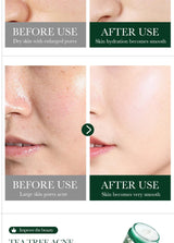 SADOER Tea Tree Acne Removing Face Cream Anti Acne Hydrating Oil Control Moisturizing Facial Creams Face Skin Care Products