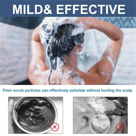 Fast Anti Exfoliating Scrub Remove Dandruff Anti Itching Treatment Seborrheic Scalp Oil Control Repair Scalp Beauty Health Care