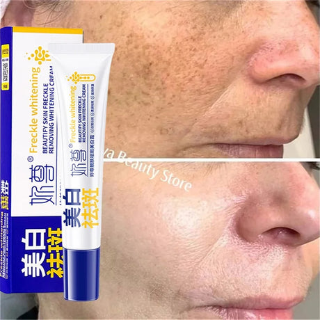 Powerful Spot-Removing Whiten Cream Brighten Skin Fast Eliminates Melanin Pigmentation Melasma Dark Spots Korean Face Skin Care