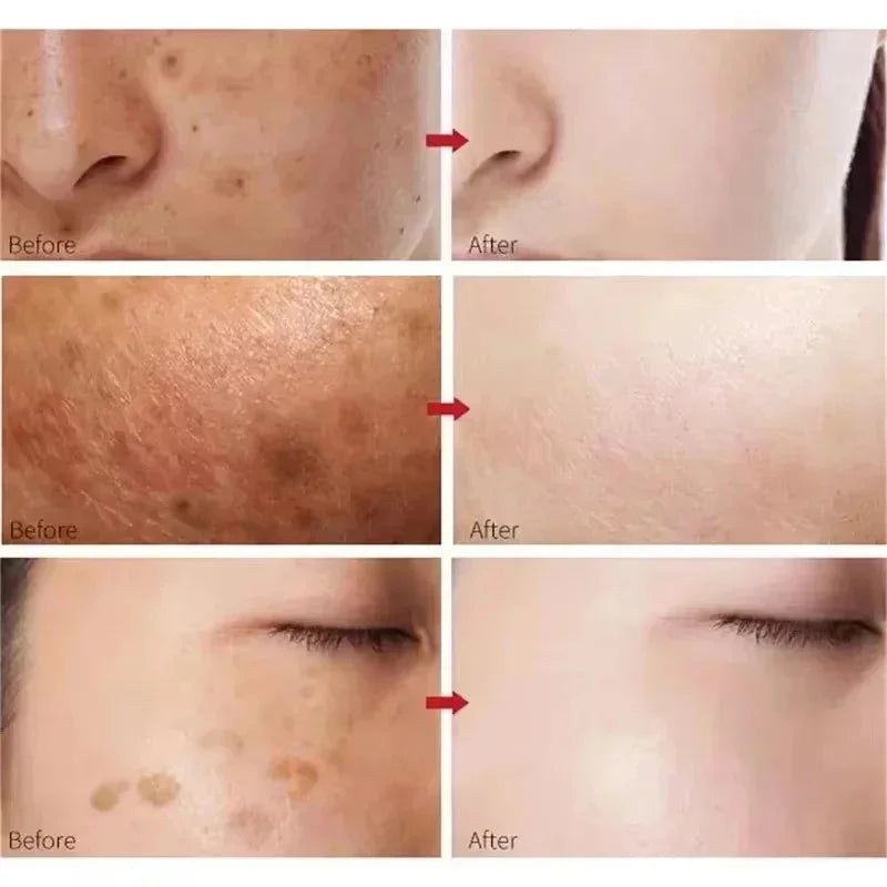 Niacinamide Dark Spot Remove Serum Face Freckle Melanin Correcting Moisturizing Brightening Anti Pigmentation Repair Skin Care