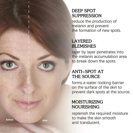 Whitening Freckles Face Cream Removal Melasma Dark Spots Corrector Lighten Melanin Pigmentation Brighten Anti-Aging Beauty Care
