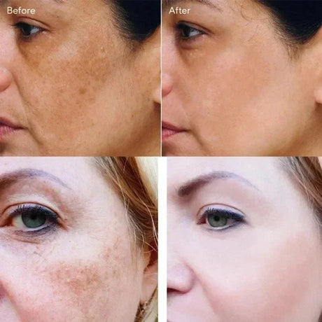 Dark Spots Remover Whitening Face Set Freckle Melanin Correcting Reduce Fine Lines Brighten Essence Korean Beauty Skin Care ﻿