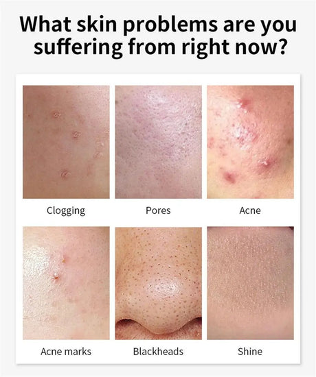 Salicylic Acid Acne Treatment Cream Repair Pimple Spots Deep Cleaning Pore Shrinking Anti-acne Oil Control Moisturizer Skin Care