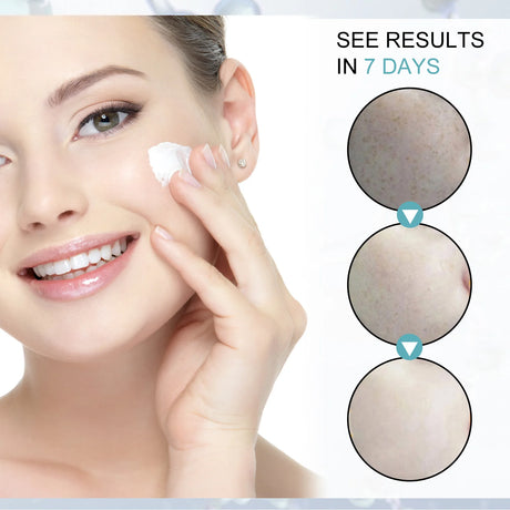 Freckle Whitening Cream Nicotinamide Fade Dark Spot Blemish Acne Mark Brightening Lightening Pigmentation Correction Cream
