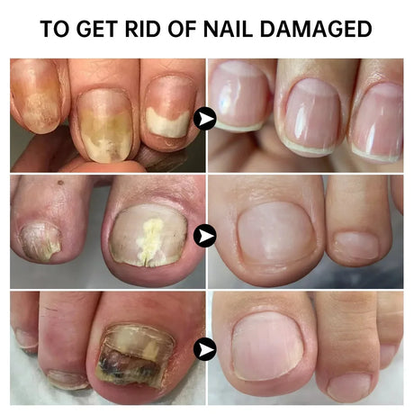 7 Days Nail Fungus Treatment Serum Ginger Anti-infective Paronychia Onychomycosis Toe Foot Nail Fungal Repair Gel Hand Foot Care