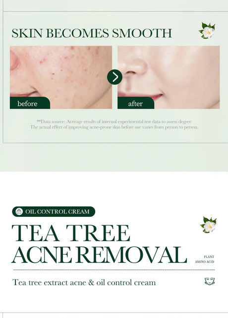 SADOER Tea Tree Acne Removing Face Cream Anti Acne Hydrating Oil Control Moisturizing Facial Creams Face Skin Care Products