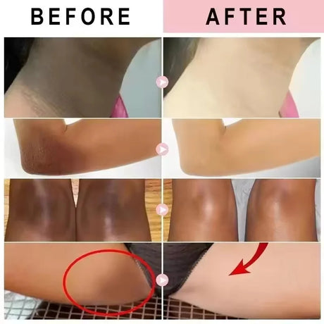 Remove Melanin Nicotinamide Brightening Cream For Dark Skin Effective Lighten Thigh Inner Bleach Private Parts Brighten Cream