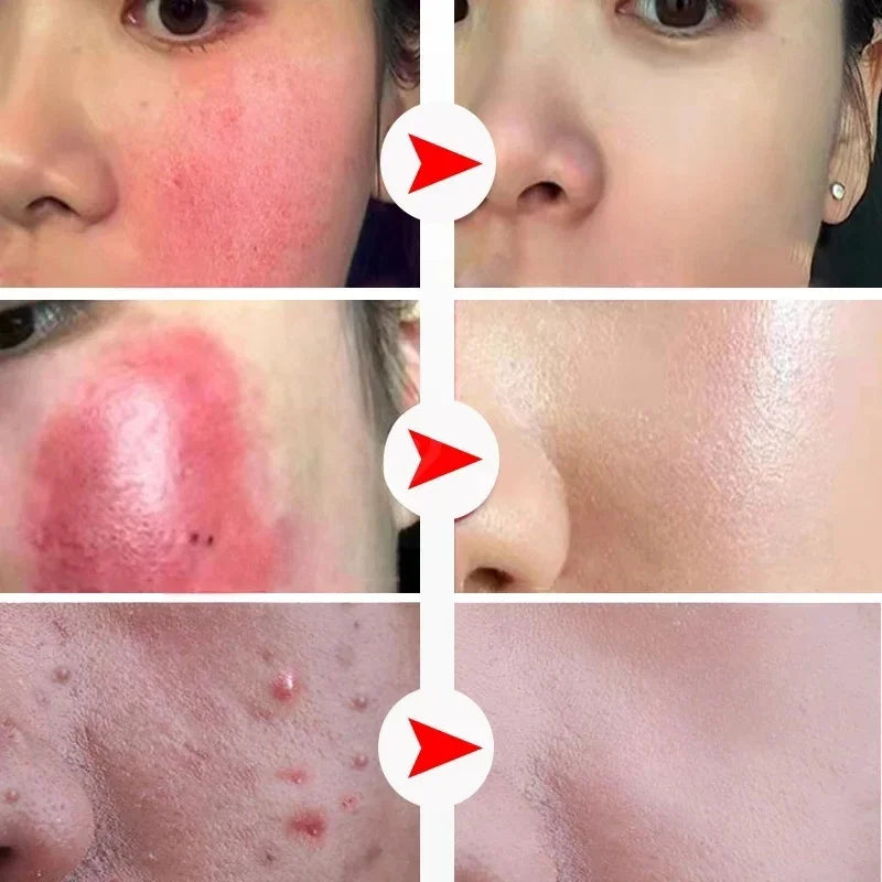 Instant Facial Redness Repair Cream Soothing Red Blood Rosacea Treatment Improve Sensitive Skin Anti Redness Skin Care Cosmetics