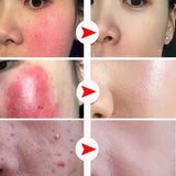 Instant Facial Redness Repair Cream Soothing Red Blood Rosacea Treatment Improve Sensitive Skin Anti Redness Skin Care Cosmetics