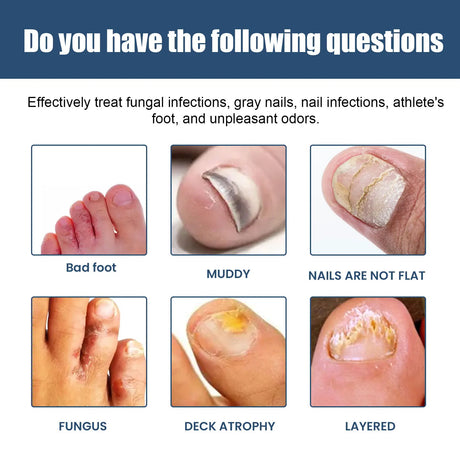 South Moon Foot Spray Anti Smell Remove Toenail Fungal Paronychia Onychomycosis Care Deodorant Antiperspirant Nail Repair Spray