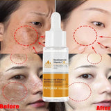 Dark Spots Remover Whitening Face Set Freckle Melanin Correcting Reduce Fine Lines Brighten Essence Korean Beauty Skin Care ﻿