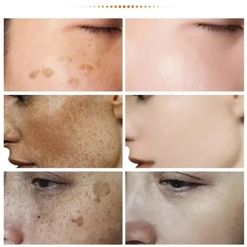 Powerful Spot-removing Whitening Freckles Cream Remove Melasma Dark Spots Fade Pigmentation Acne Moisturizing Brighten Skin Care