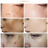 Powerful Spot-removing Whitening Freckles Cream Remove Melasma Dark Spots Fade Pigmentation Acne Moisturizing Brighten Skin Care