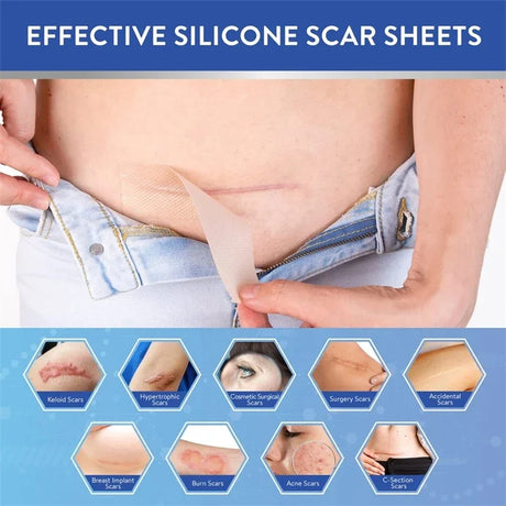 Silicone Scar Sheets - Reusable Scar Tape for Keloid, C-Section, Surgery, Burn, Acne - Waterproof, Hypoallergenic, Latex-Free