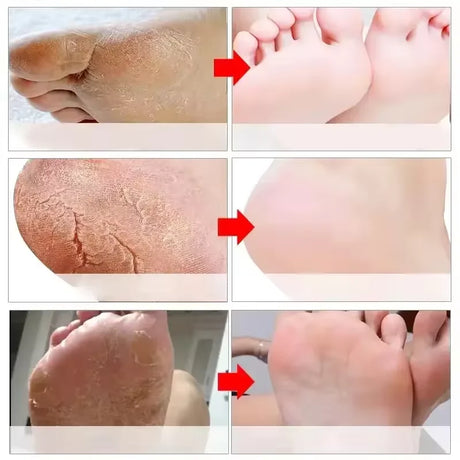 Herbal Anti Crack Foot Cream Spray Heel Cracking Repair Products Exfoliation Dead Skin Removal Softening Moisturize Smooth Care