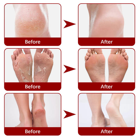 Exfoliating Feet Mask Sock Exfoliation Scrub for Feet Mask Remove Dead Skin Moisturizing Pedicure Anti Crack Foot Patch Spa 5PCS