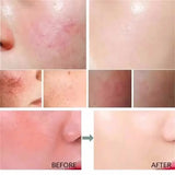 Facial Redness Repair Serum Improve Sensitive Skin Dryness Moisturizer Hydrating Sooth Lotion Removal Rosacea Korean Cosmetics
