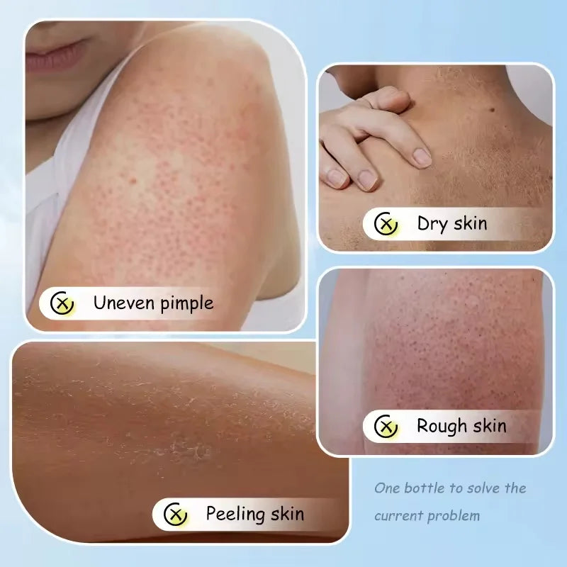 Keratosis Pilaris Repair Treatment Cream Exfoliating Removal Chicken Skin Cleaning Acne Spots Moisturizing Smooth Body Skin Care