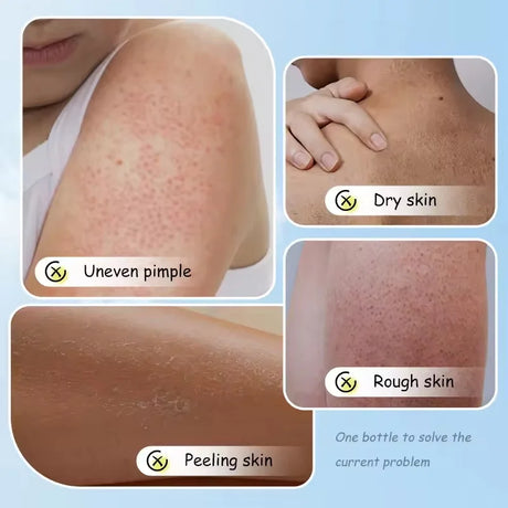 Keratosis Pilaris Repair Treatment Cream Exfoliating Removal Chicken Skin Cleaning Acne Spots Moisturizing Smooth Body Skin Care