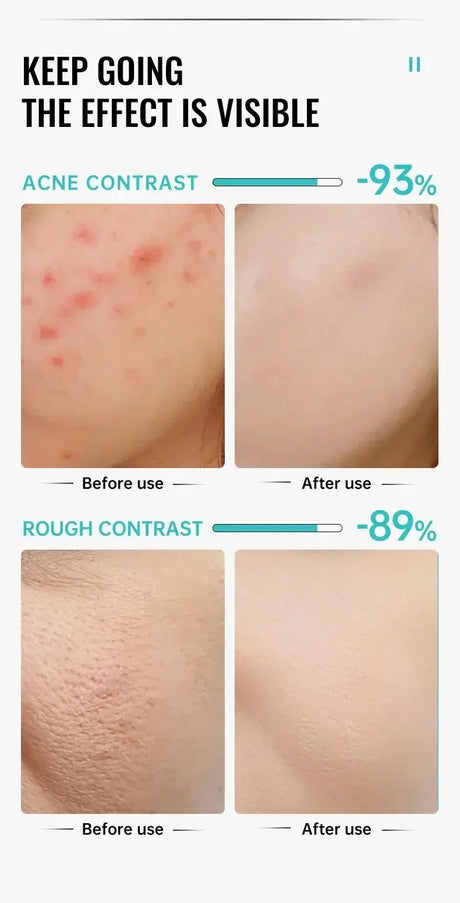 Salicylic Acid Acne Treatment Face Cream Repair Pimple Spots Deep Cleaning Pore Anti-acne Scar Oil Control Moisturizer Skin Care