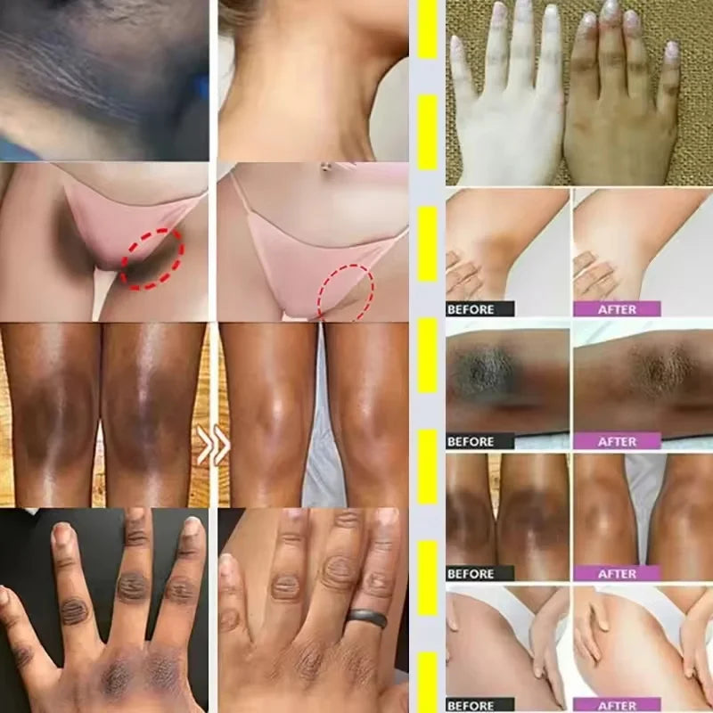 Body Whitening Cream Dark Skin Armpit Lightening Intimate Areas Underarm Bleaching Private Parts Whiten Cream Body Lotion Beauty