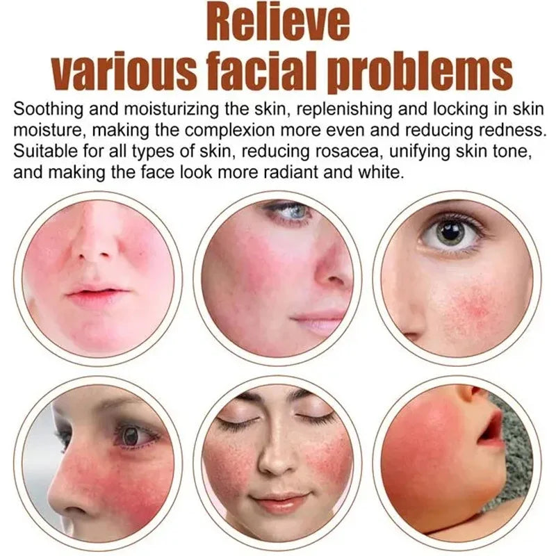 Instant Facial Redness Repair Cream Soothing Red Blood Rosacea Treatment Improve Sensitive Skin Anti Redness Skin Care Cosmetics