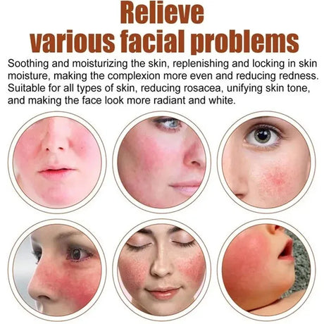 Instant Facial Redness Repair Cream Soothing Red Blood Rosacea Treatment Improve Sensitive Skin Anti Redness Skin Care Cosmetics
