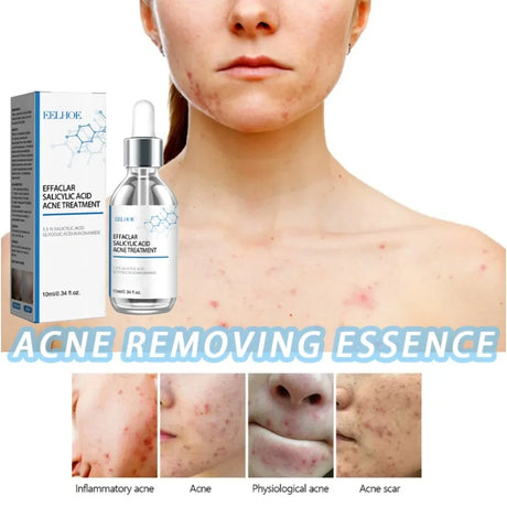 Face Serum Fruit Acid Acne Treatment Oil Control Remove Blackheads Shrink Pores Skin Texture Improve Care