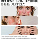 Anti-Acne Cream Effectively Removes Skin Nodules Pustules Cysts Papules Blackheads Men And Women Acne Skin Care Essence Cream