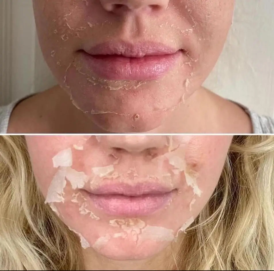 High Quality 50% Chemical Peel Acid Skin Superforce Pigmentation Lightening Melanin Acne Treatment Remove Scar