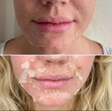 High Quality 50% Chemical Peel Acid Skin Superforce Pigmentation Lightening Melanin Acne Treatment Remove Scar