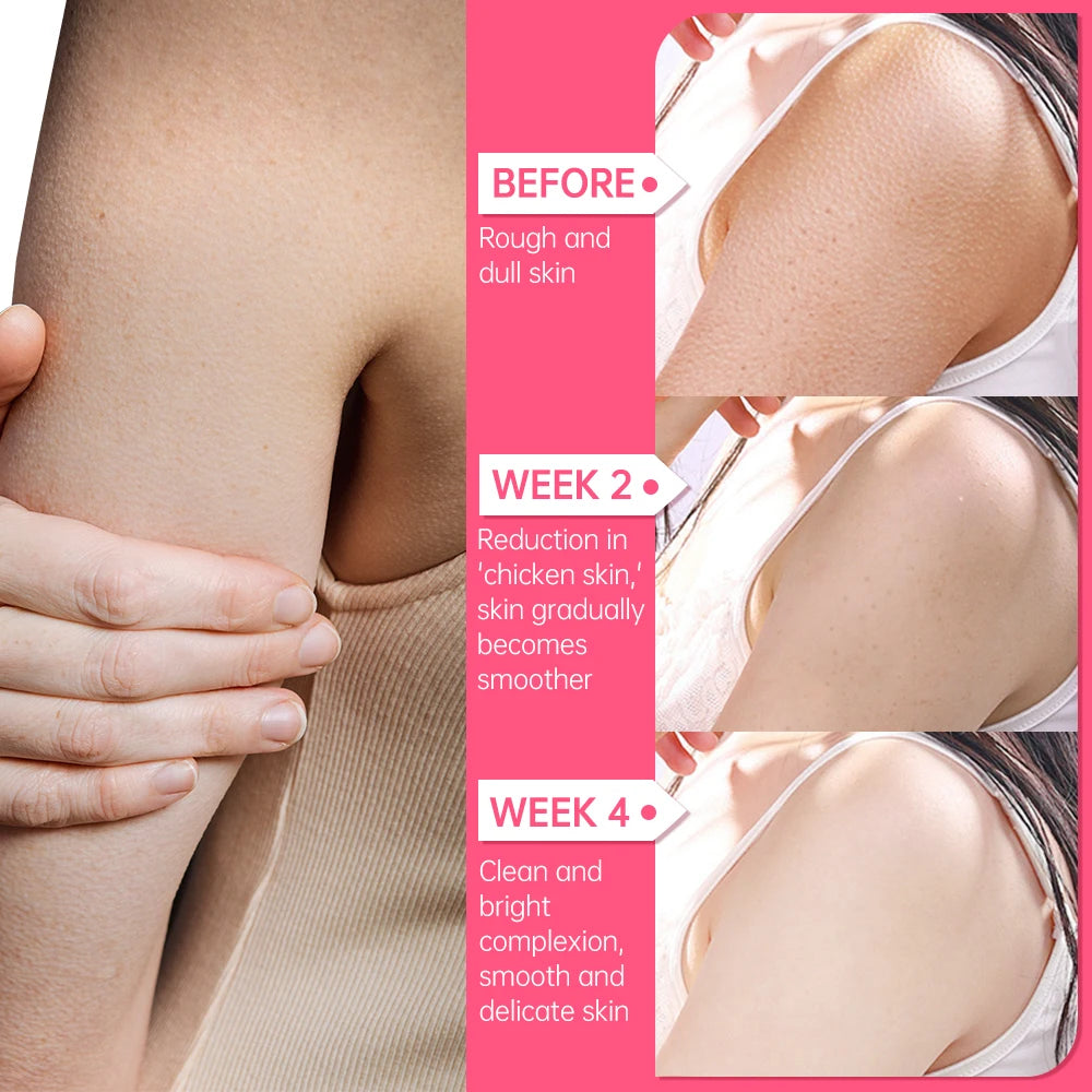 Chicken Skin Removal Cream Body Curing Keratosis Follicle Pore Spot Dull Treatment Whitening Moisturizing Body Care JoyPretty