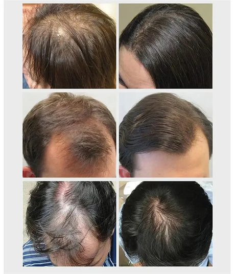 Hair Growth Serum 7 Days Fast Regrowth Essential Capsule Anti Hair Loss Baldness Repair Damaged Scalp Treatment For Women Men