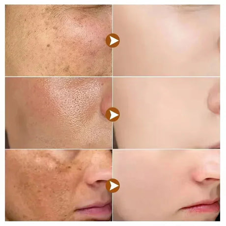 Niacinamide Dark Spot Remove Serum Face Freckle Melanin Correcting Moisturizing Brightening Anti Pigmentation Repair Skin Care