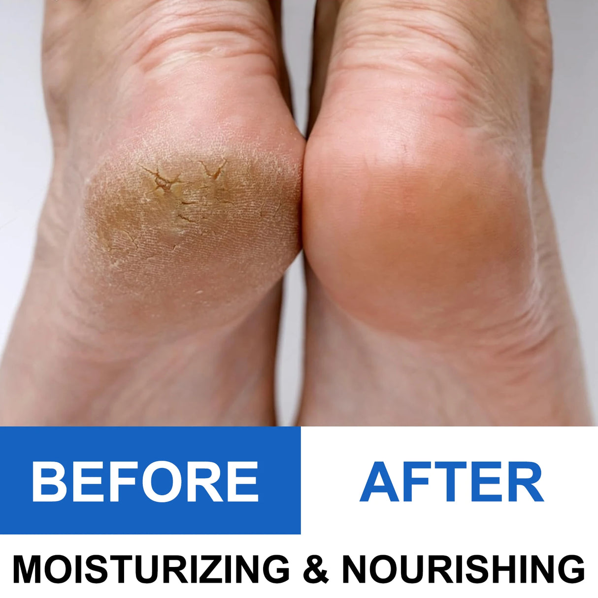 40% Urea Foot Cream Stick - Moisturizing & Exfoliating Cracked Heel Repair Deep Hydration for Dry Feet Long protect