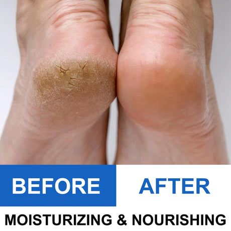 40% Urea Foot Cream Stick - Moisturizing & Exfoliating Cracked Heel Repair Deep Hydration for Dry Feet Long protect