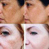 Dark Spots Remover Whitening Face Set Freckle Melanin Correcting Reduce Fine Lines Brighten Essence Korean Beauty Skin Care ﻿