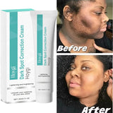 Powerful Spot-removing Whitening Freckles Cream Remove Melasma Dark Spots Fade Pigmentation Acne Moisturizing Brighten Skin Care